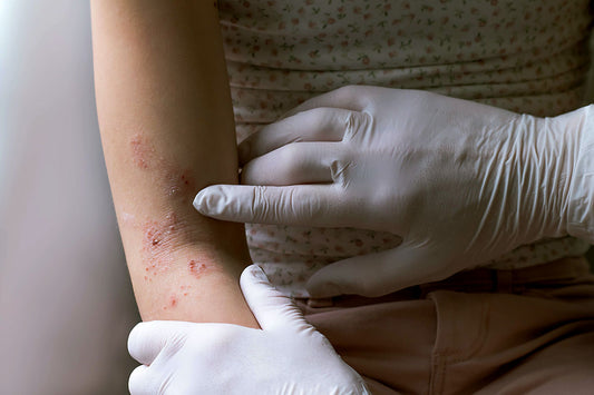 BioLounge eczema 